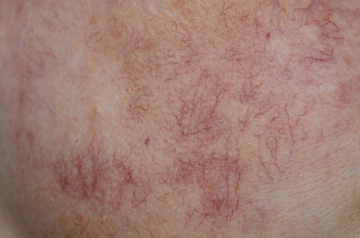 Sterex Advanced Blemish Removal